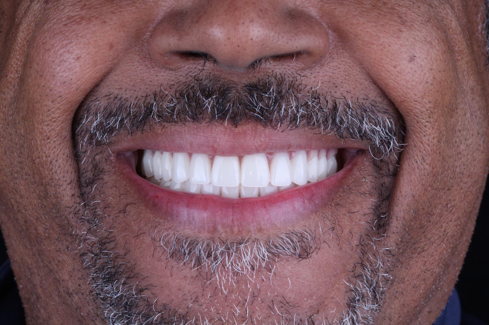 Jonathan, after full-arch treatment, close-up of smile