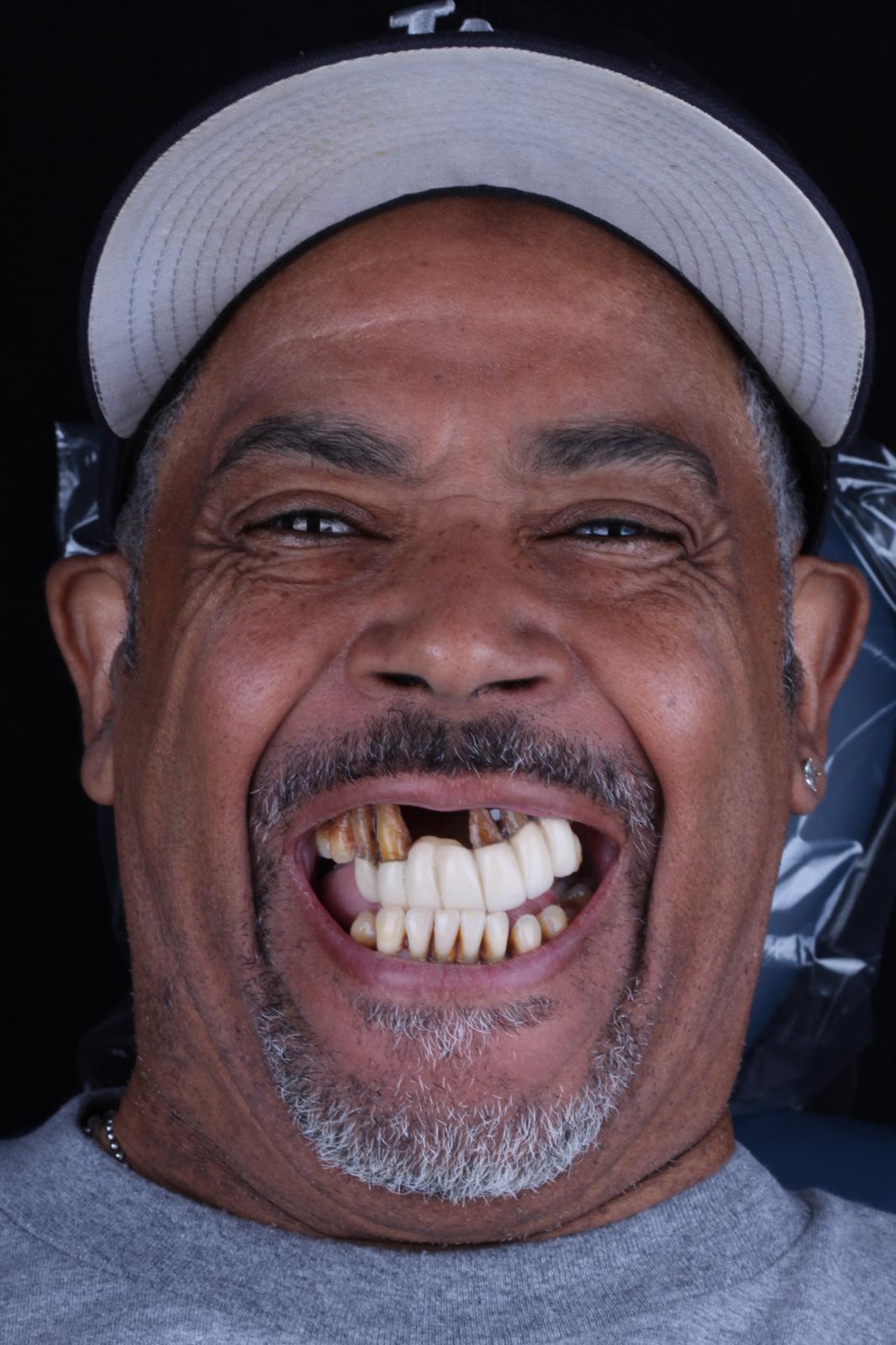 Jonathan, before full-arch treatment