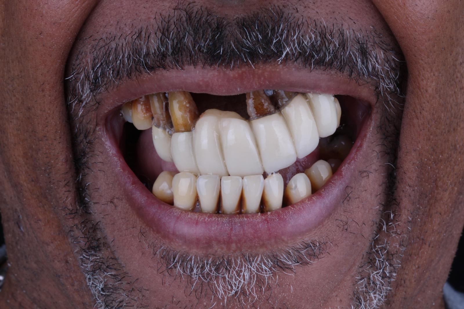 Jonathan, before full-arch treatment, close-up of smile