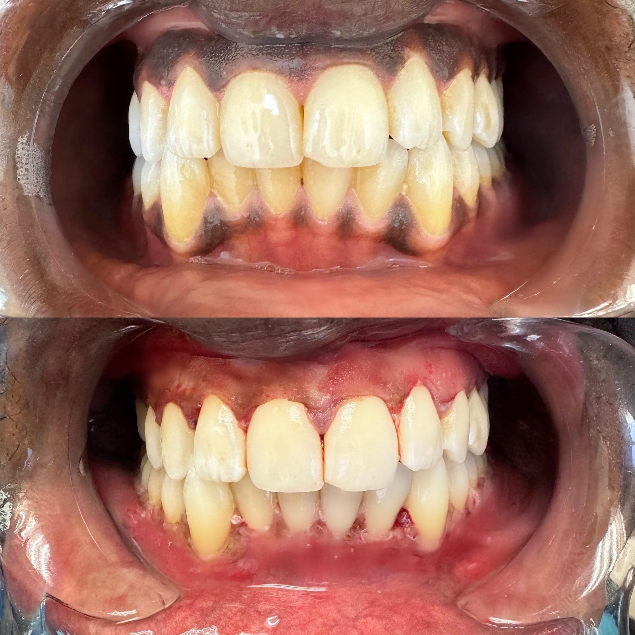 Laser gum lightening, before and after, a Sterling patient
